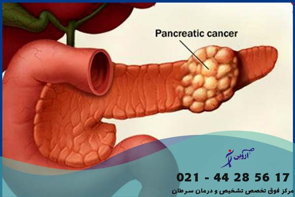 تشخیص سرطان پانکراس