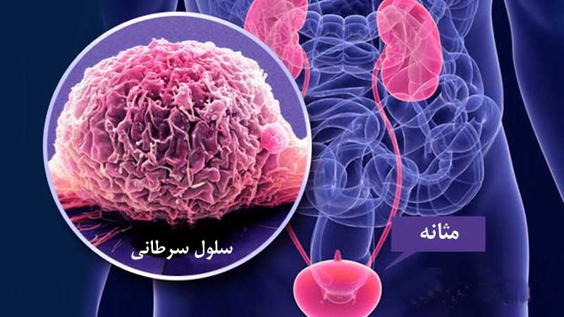تشخیص سرطان مثانه
