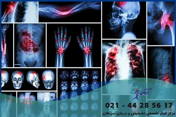انواع رادیوتراپی سرطان استخوان