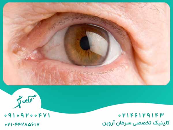 درمان سرطان چشم لنفوم