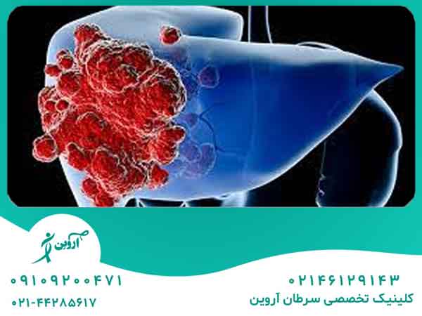 شیمی درمانی سرطان کبد در انواع مراحل