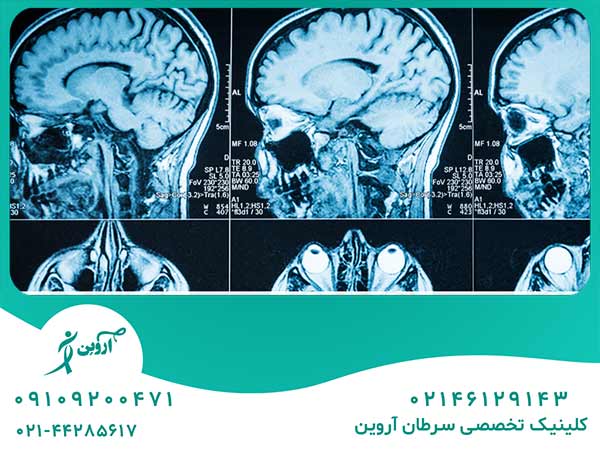 انواع روشهای درمان پس از تشخیص تومور مغزی