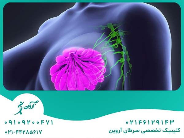 ارتباط بین سرطان سینه و غدد لنفاوی