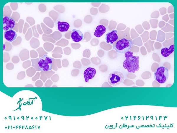 لوسمی سلول T بالغین