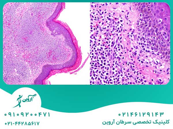تشخیص لوسمی سلول T بالغین
