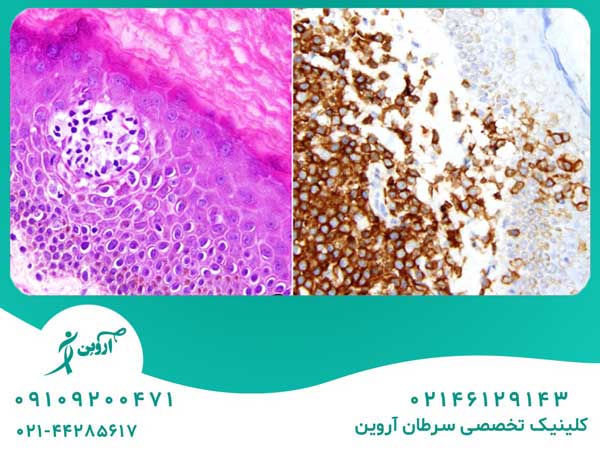 درمان لوسمی سلول T بالغین