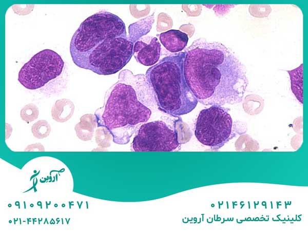 لوسمی سلول T بالغین در کلینیک آروین