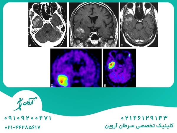 تشخیص لنفوم اولیه مغز